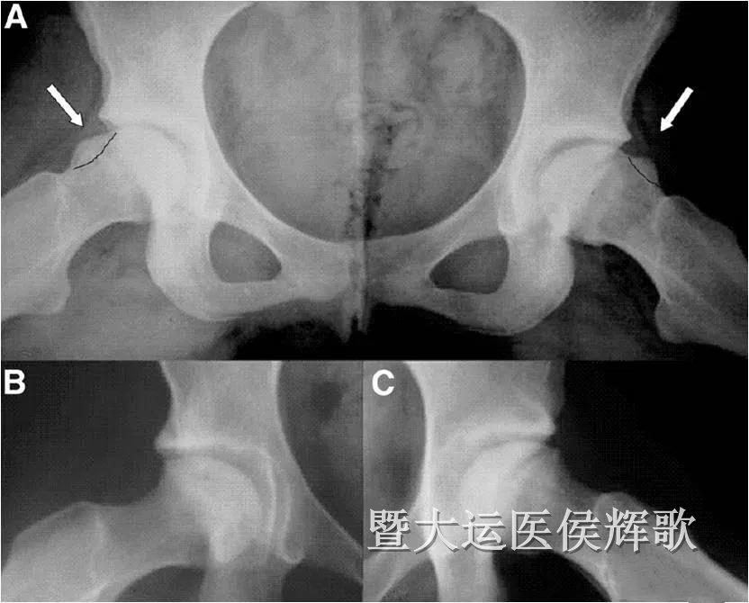 360°放射状的薄层单髋核磁) 2,拍x光片(包括髋关节正位,蛙式位,dunn