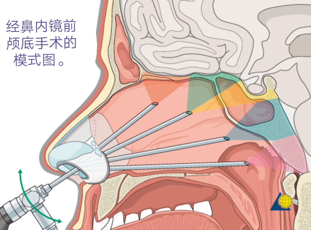 垂体瘤以及经鼻内镜垂体和颅底手术-樊韵平