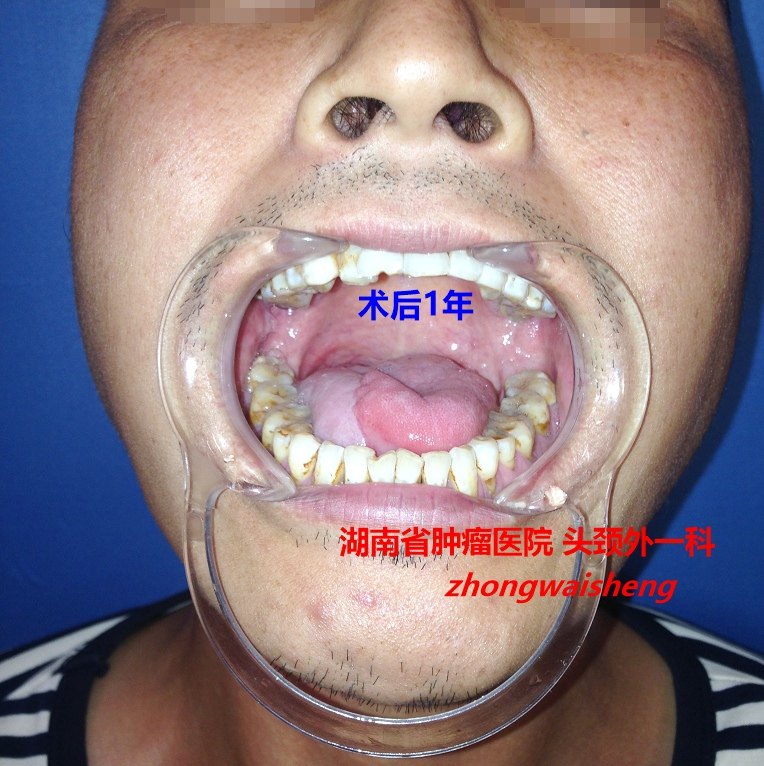 不切开下唇的手术方式治疗舌癌(附图片)