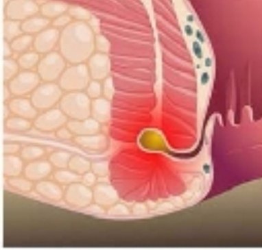 四图看懂肛周脓肿到肛瘘演变过程