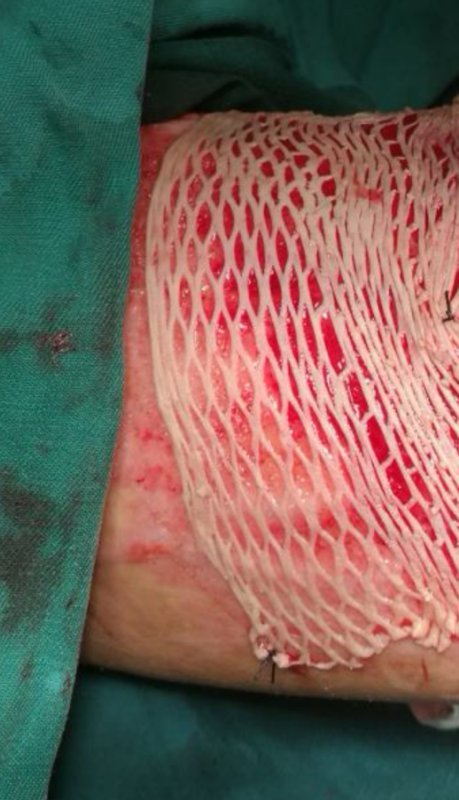 伤口植皮术是如何在人体取皮的