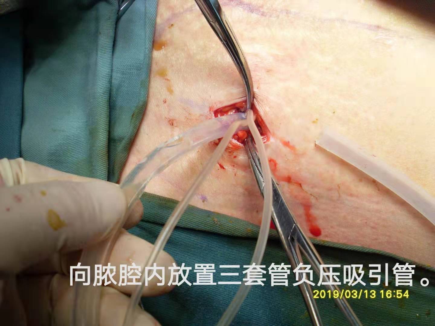 病例(24)--巨大囊肿 气液平是肠管扩张还是自发肠瘘