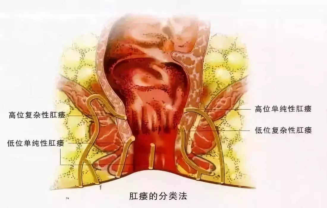 肛瘘的症状主要有哪些?