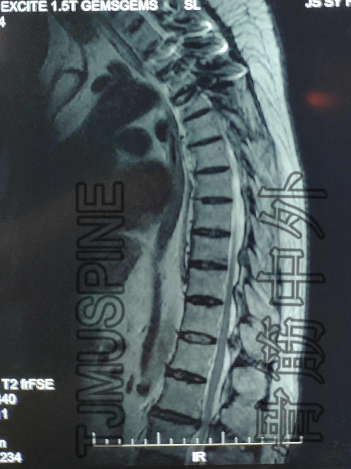 t2-t4融合内固定 t8/9 t9/10 t10/11 t11/12 t12/l1 术前胸腰椎mri