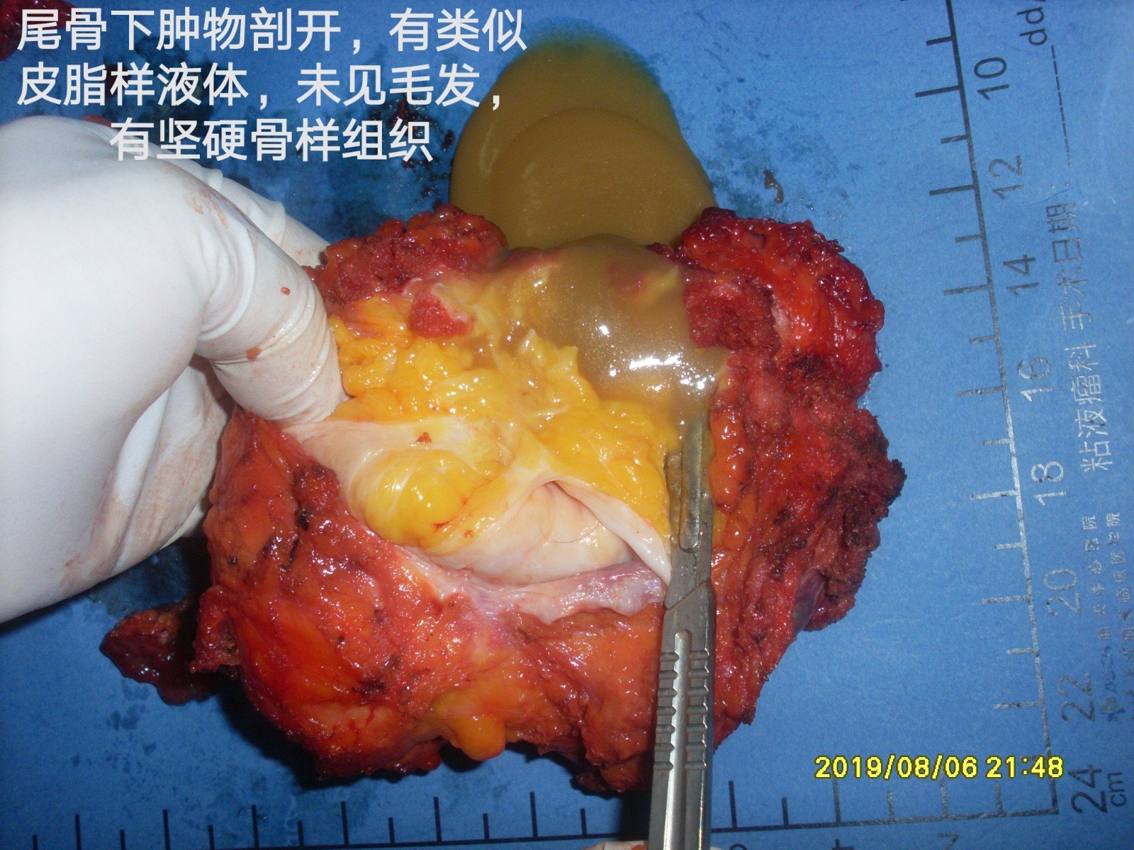 病例110--骶尾部先天性黏液性畸胎瘤复发累及腹腔成pmp