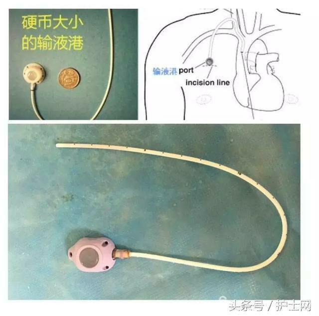 输液港植入术:长期输液者的福音