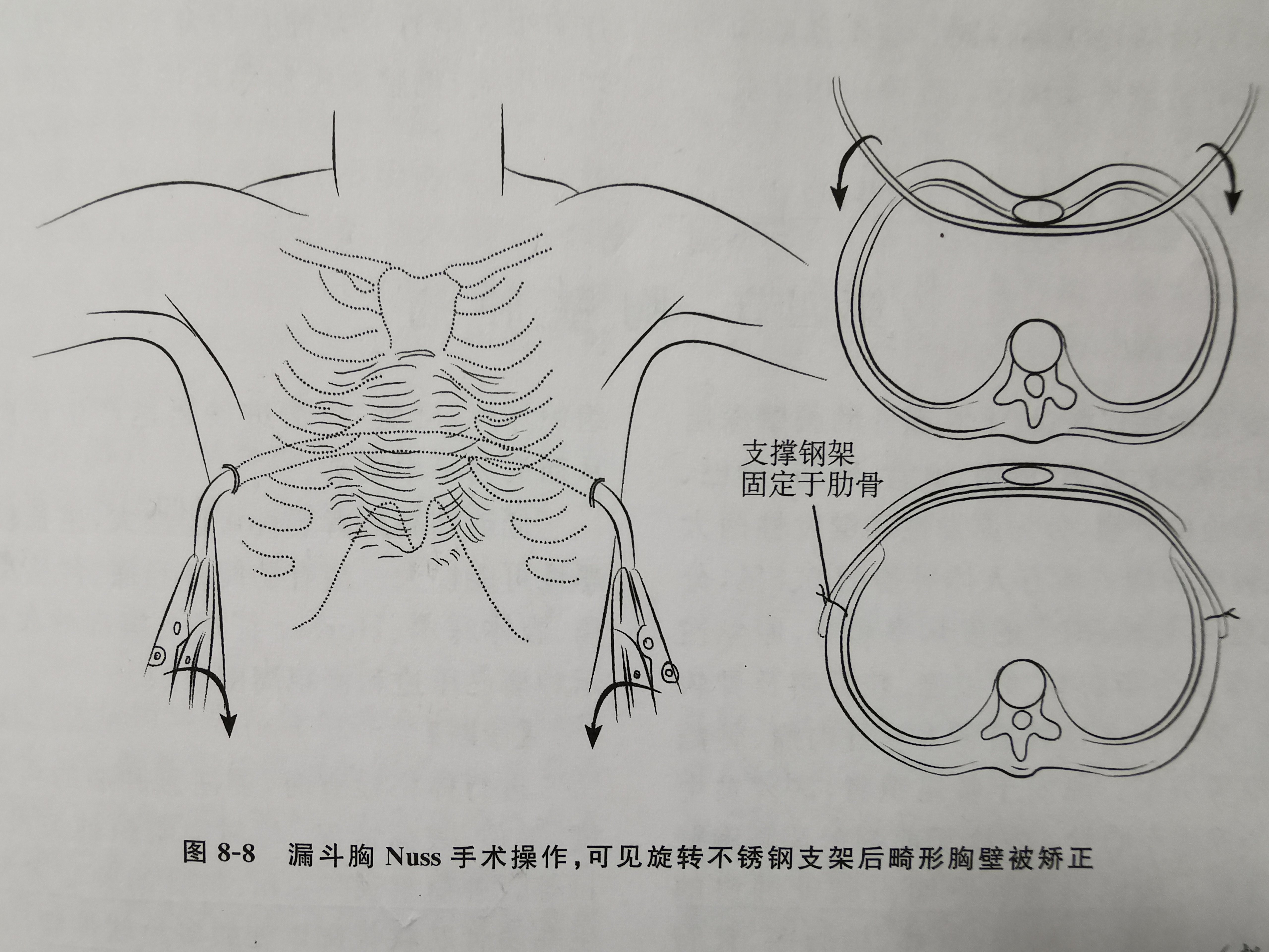 周晓详解微创漏斗胸矫正术(nuss手术)