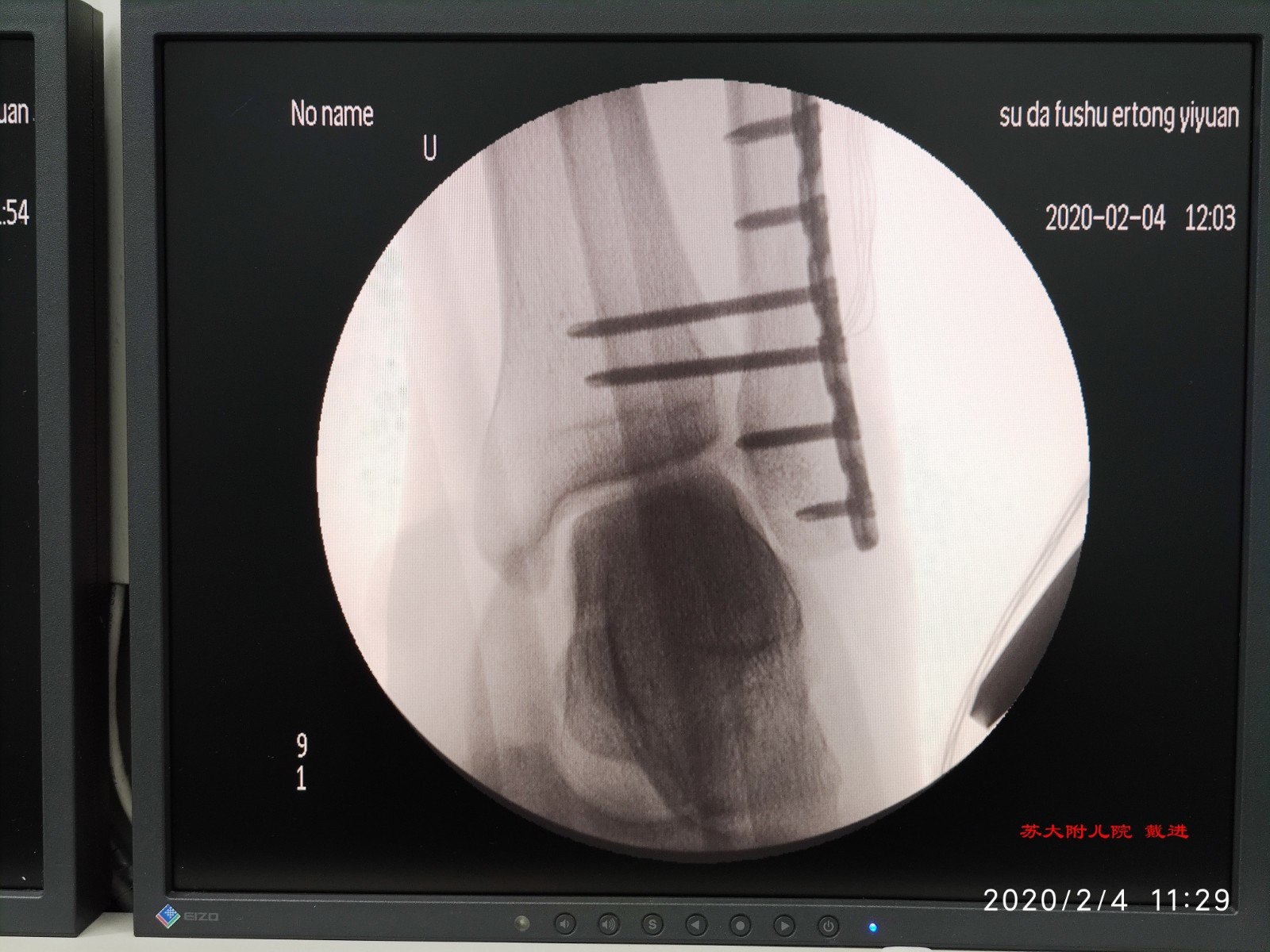 点状复位钳复位分离的下胫腓关节,两枚长螺钉固定,再次透视下胫腓和踝