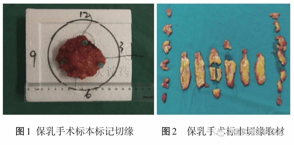 论著早期乳腺癌病人保乳手术标本病理切缘评价临床价值研究