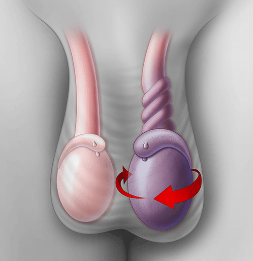 提示左侧睾丸扭转.