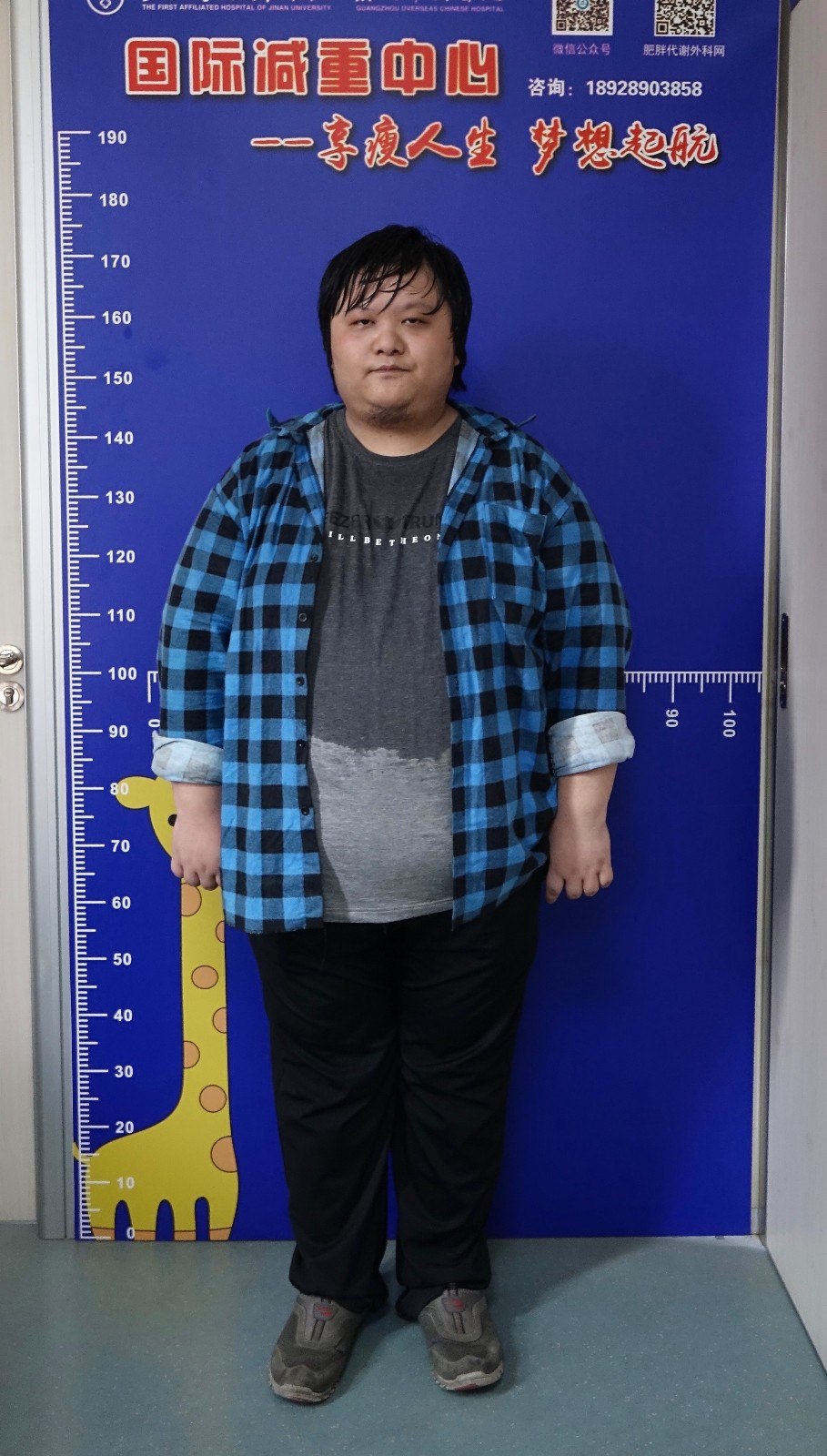 减肥手术前后对比照