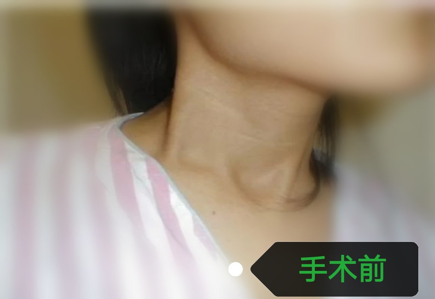 斜颈能不能完全康复?
