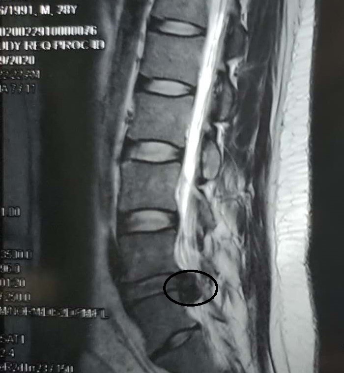 图示巨大的腰4/5 椎间盘髓核脱出并且游离