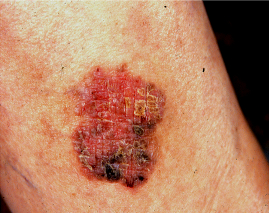 鳞状细胞癌早期会表现为皮肤上,尤其是日光暴露部位的红斑,斑块,表面