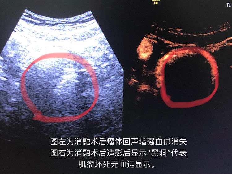 子宫肌瘤子宫腺肌瘤的精准微无创治疗方法-微波消融术
