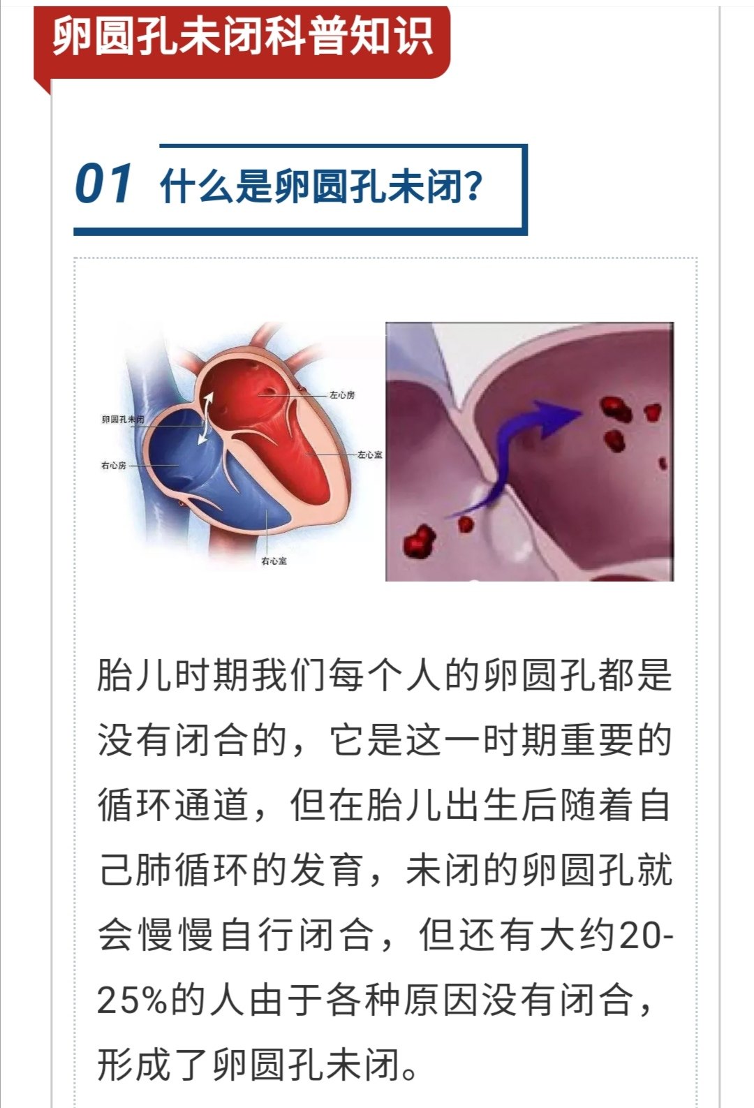 卵圆孔未闭封堵——江西周裔忠主任医师