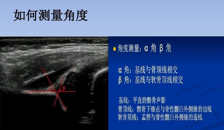 2, barlow试验,又称"稳定"试验,是 tolani试验的改良 这两种方法都不