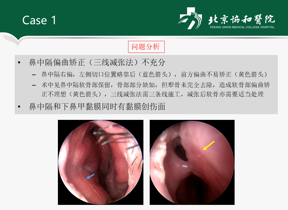 鼻中隔矫正术后或下鼻甲术后鼻腔粘连的处理