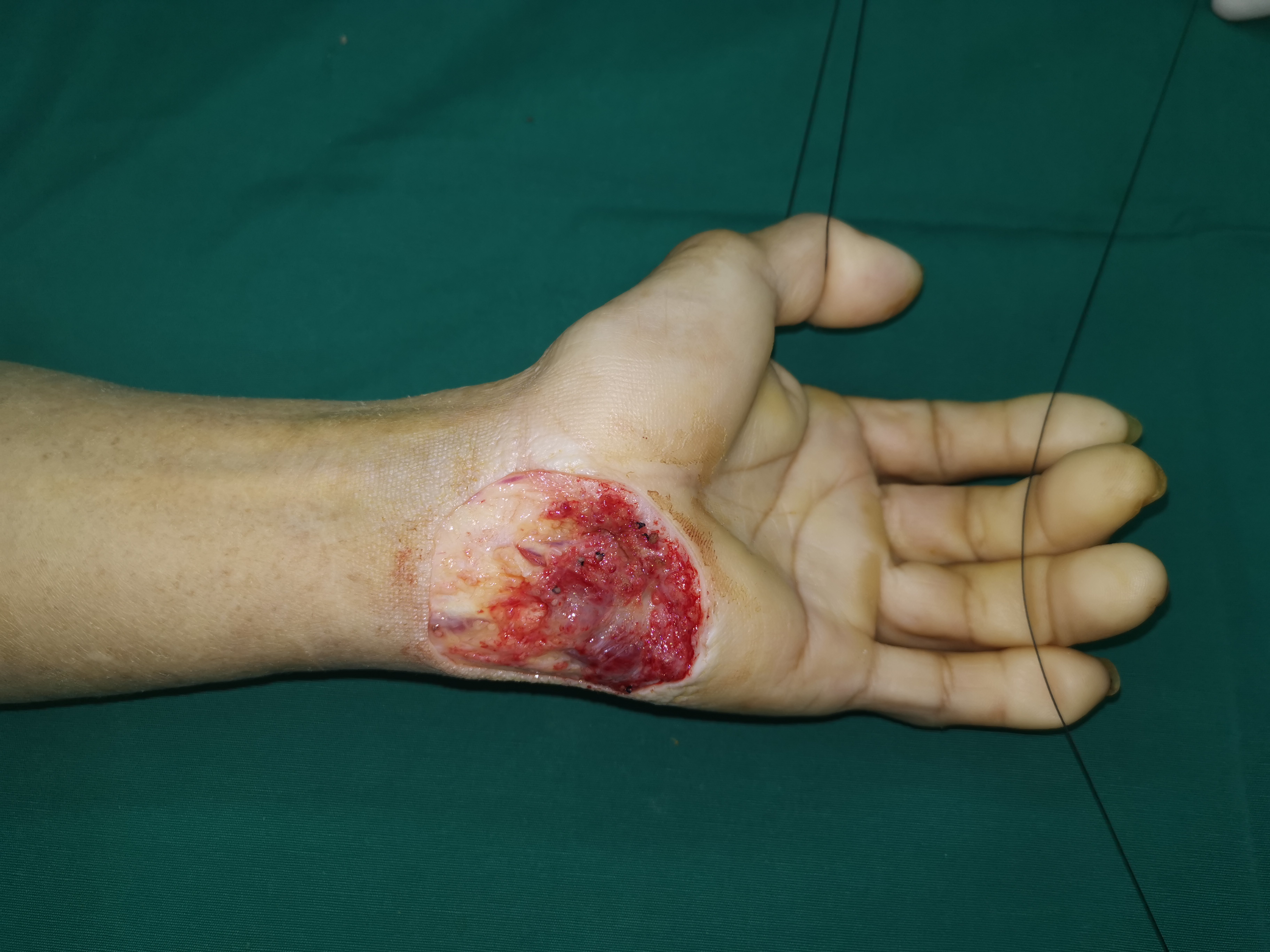 手掌皮肤缺损修复