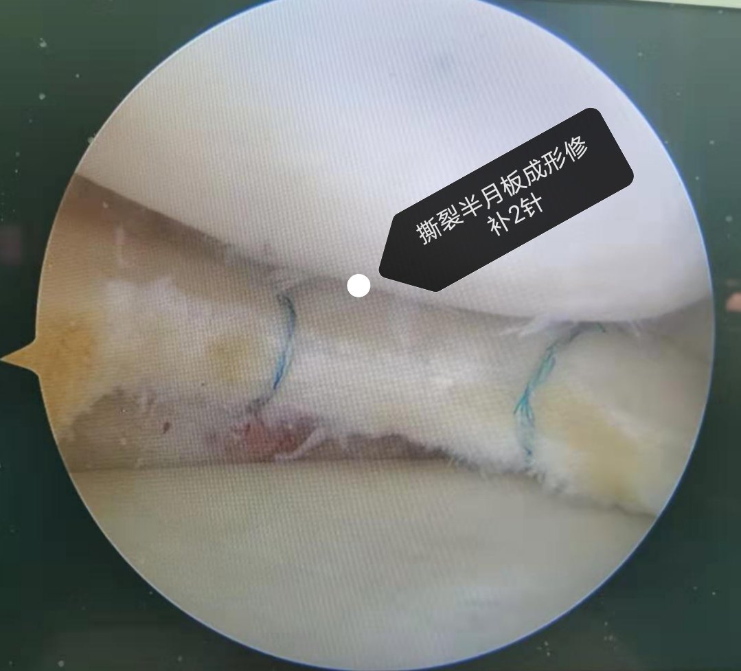 半月板撕裂能否自行愈合?can a meniscus tear heal on its own?