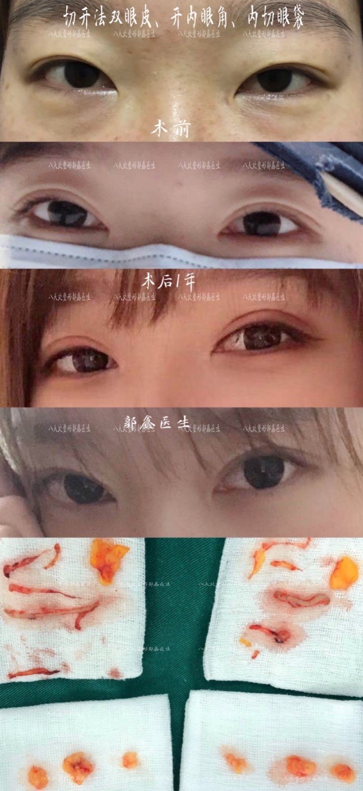 case 40 切开法双眼皮 开内眼角 ,内切眼袋