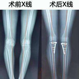 膝关节骨关节炎的阶梯化治疗