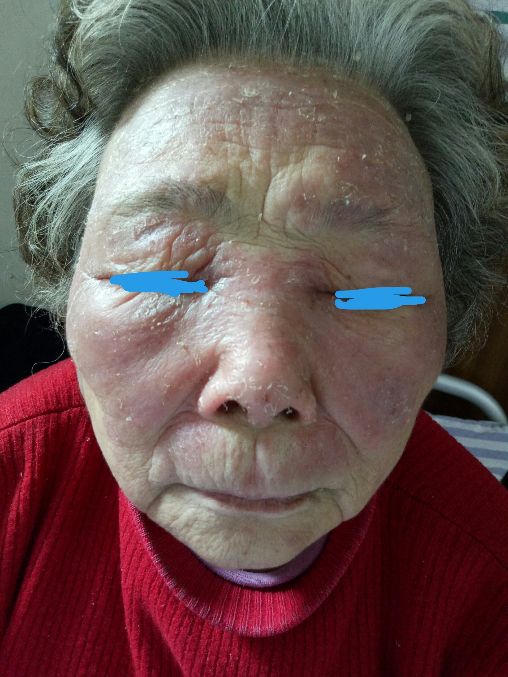 脸部日光性皮炎症状图图片