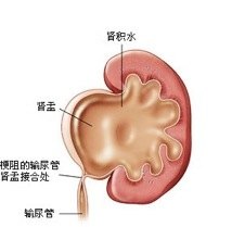 小儿肾积水的腹腔镜治疗