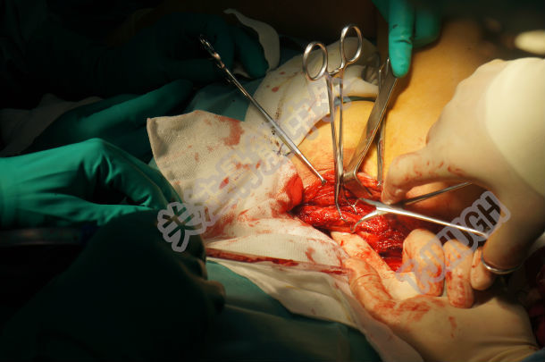 锁骨骨折微创手术图片