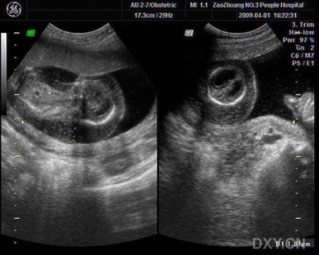 尤其是死胎伴有水肿和/或严重畸形,如无头,露脑等时,需与无心畸胎鉴别