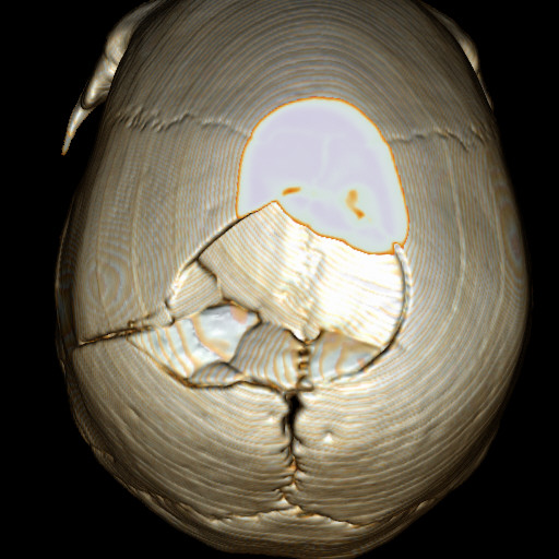 颅骨孔裂图片