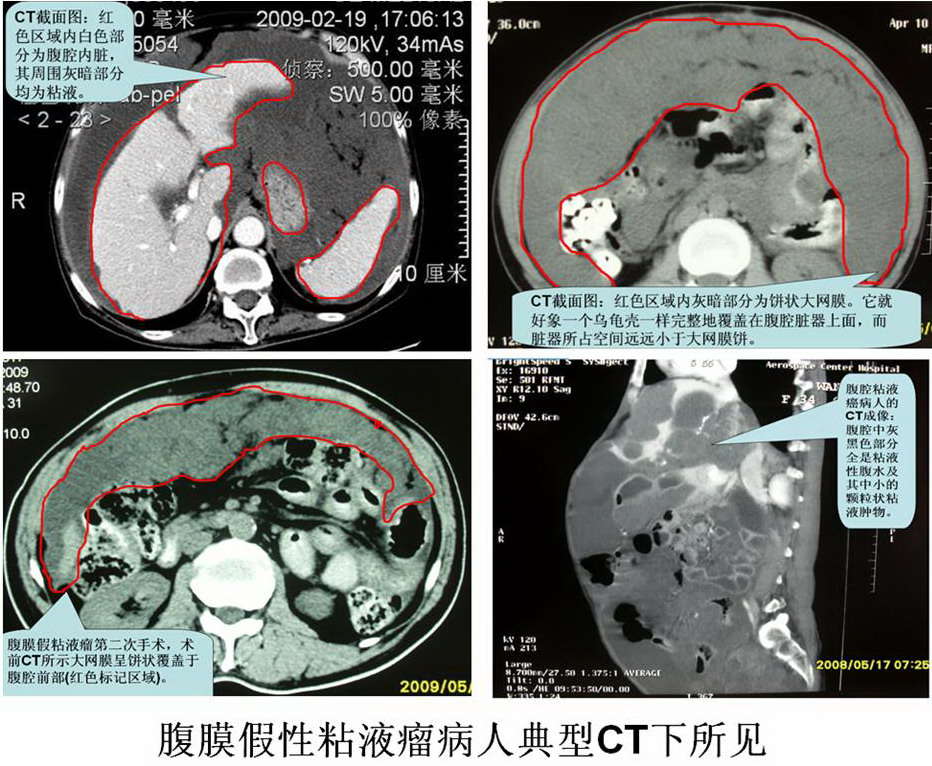 腹膜假性粘液瘤腔镜下及手术中所见 - 好大夫在线