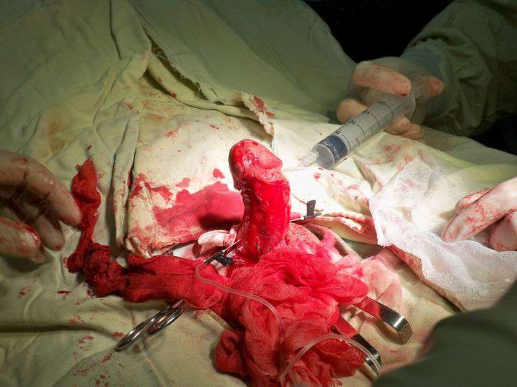 手术前阴茎勃起后有向下弯曲