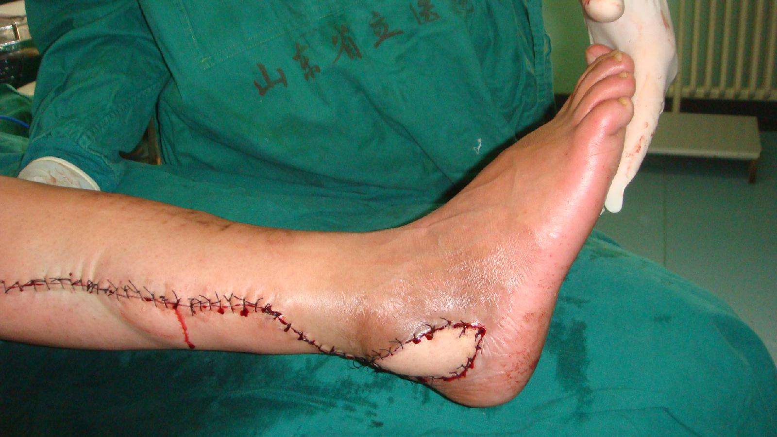 跟骨骨髓炎的治疗 - 好大夫在线