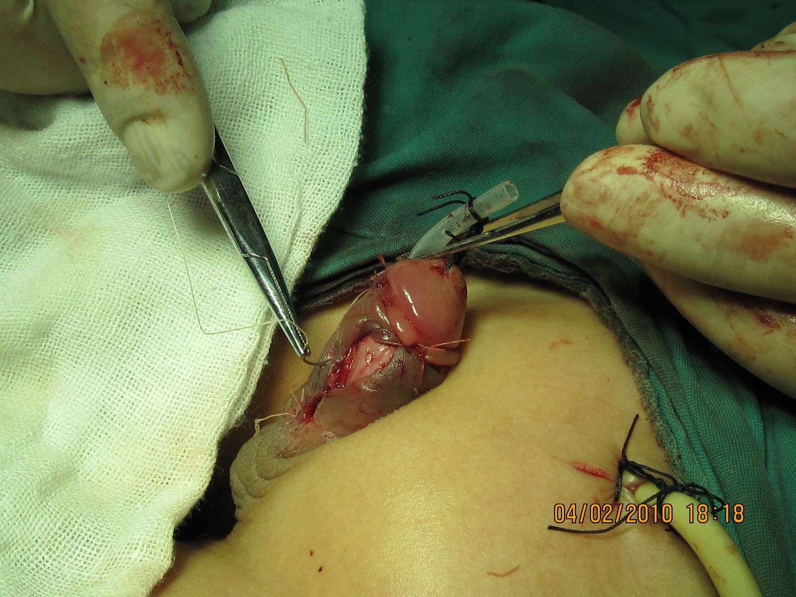尿道下裂手术实例(一) 