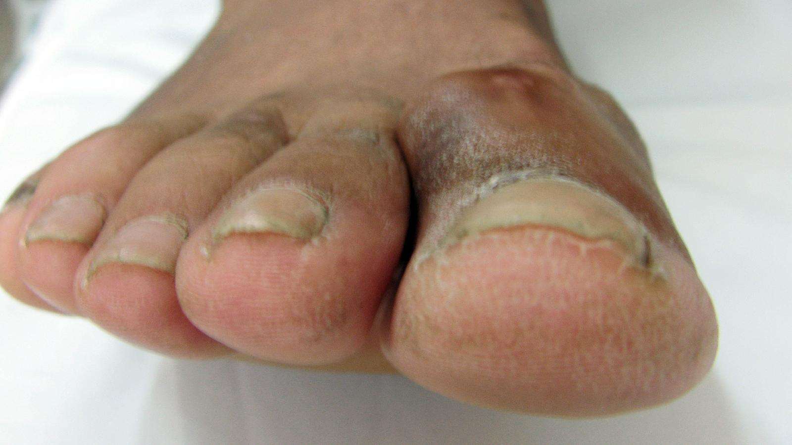 脚趾滑囊炎的症状图片图片