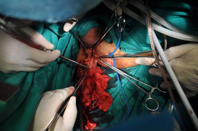 镜联合tem器械低位直肠癌外翻拖出式肛外切除吻合的腹部无切口手术