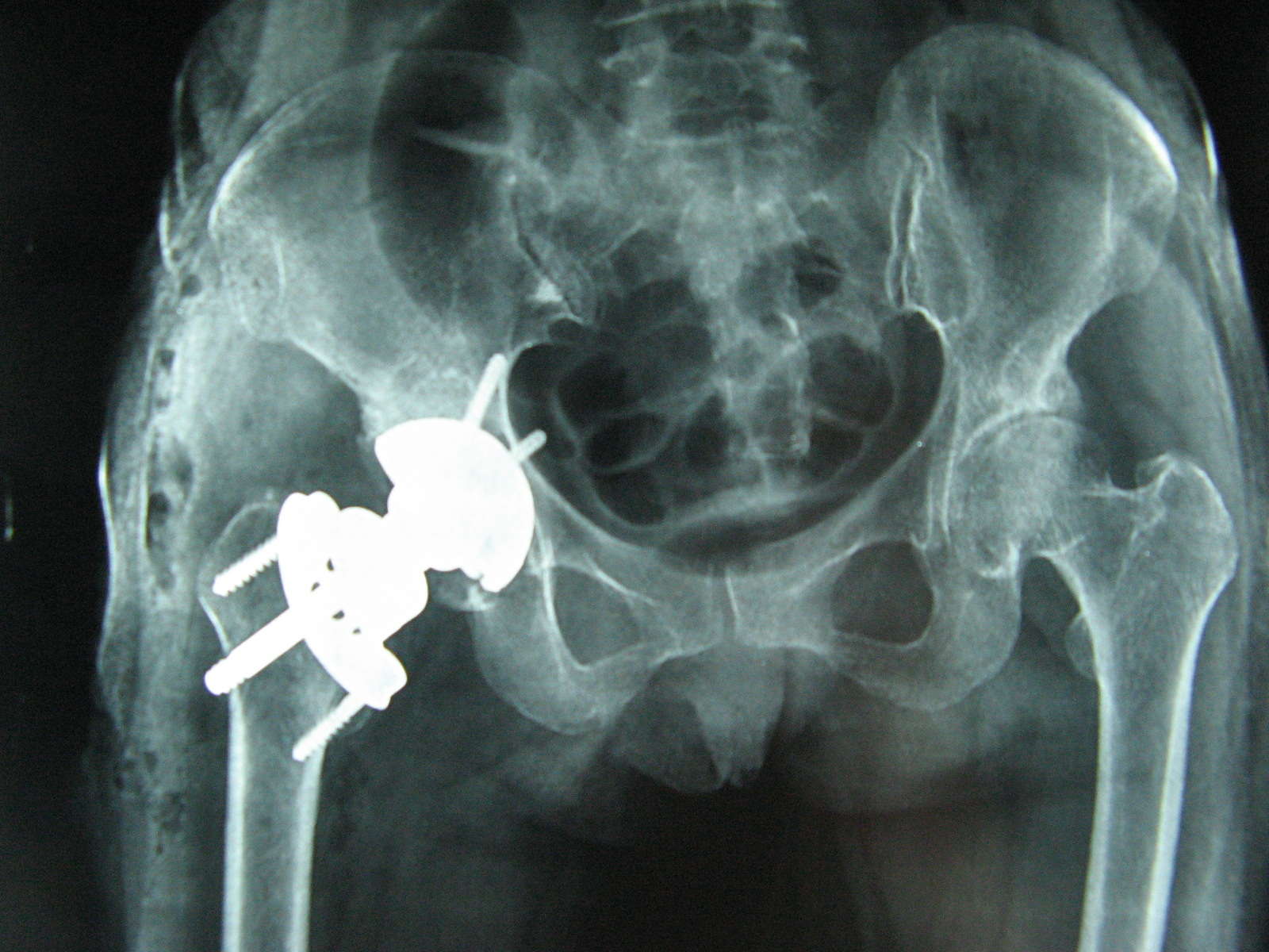 无柄人工全髋关节