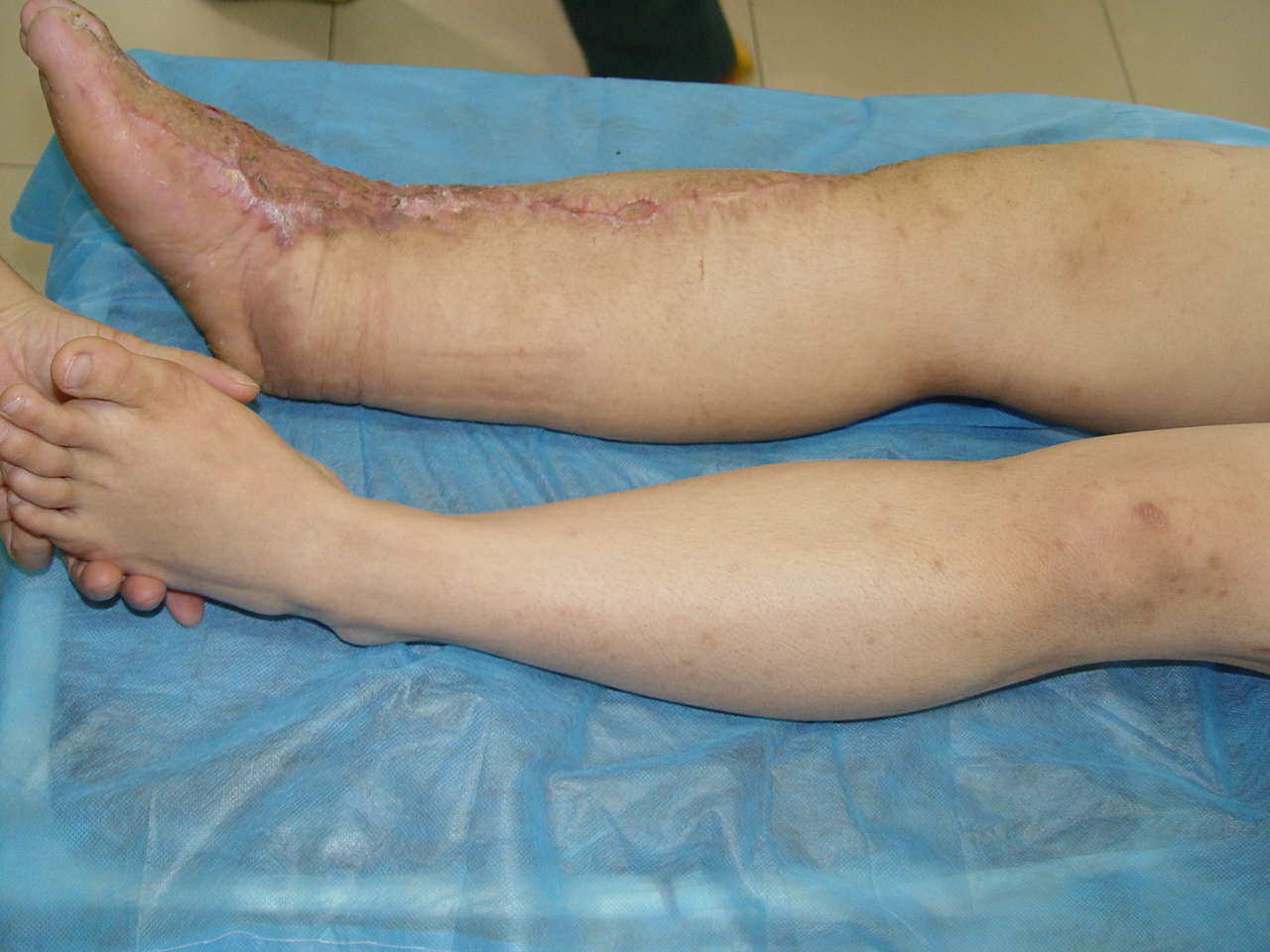 淋巴水肿图片1b(术后) 赵东红原创