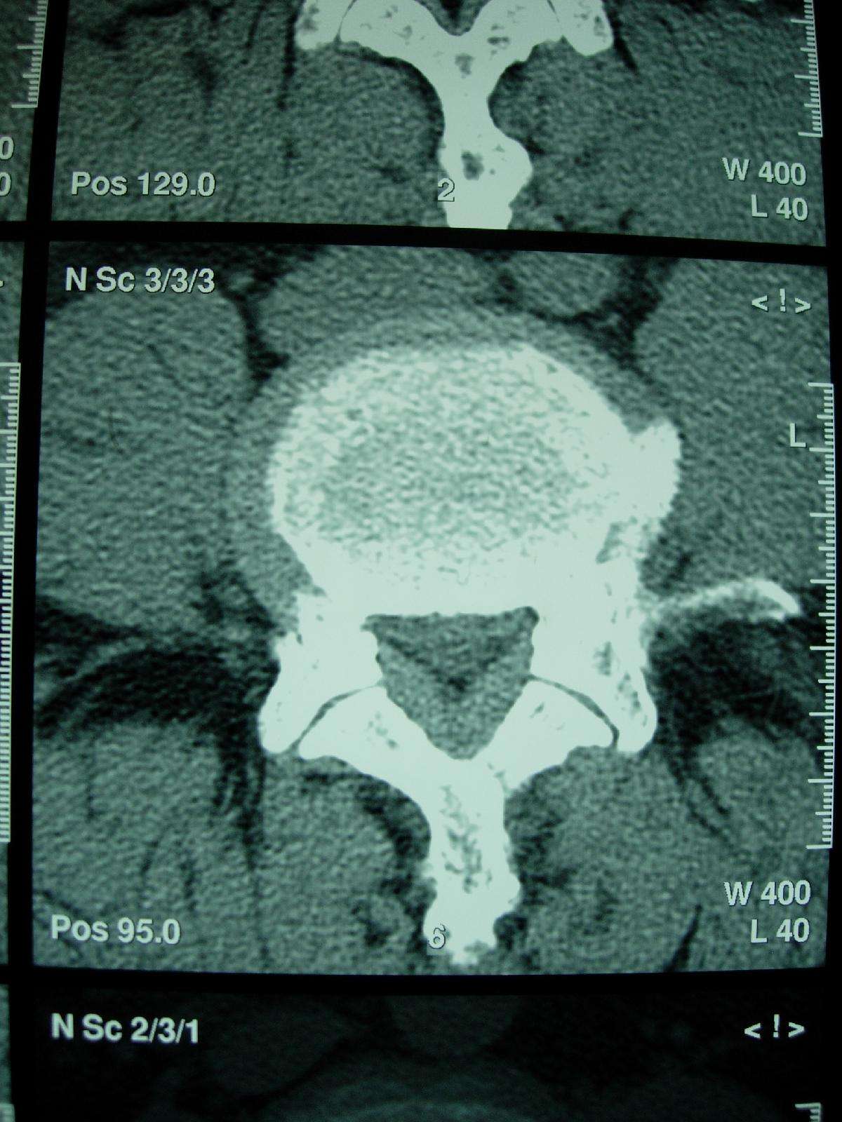 典型腰椎管狭窄的病人的影像学检查 