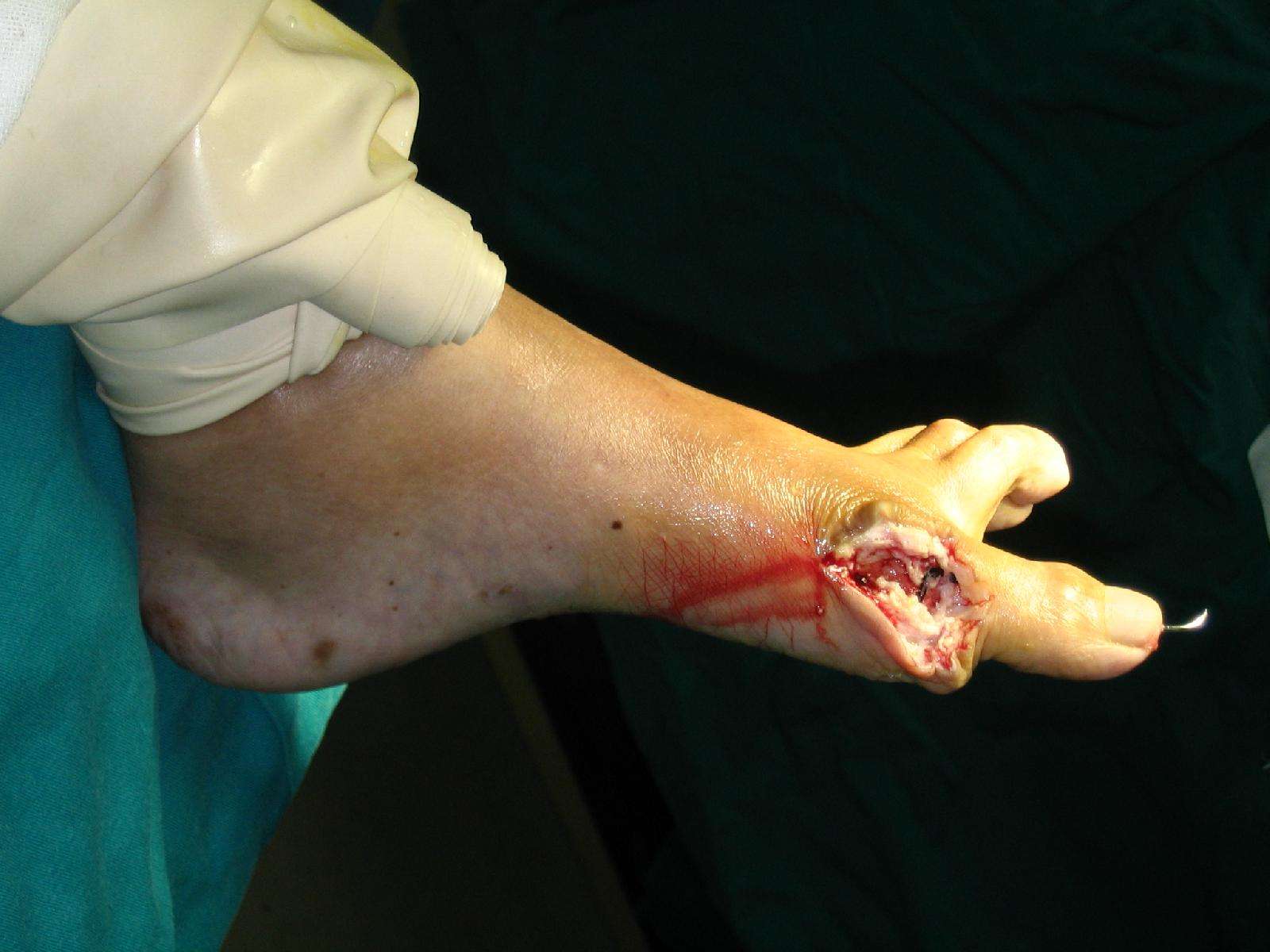 大脚骨手术过程图片