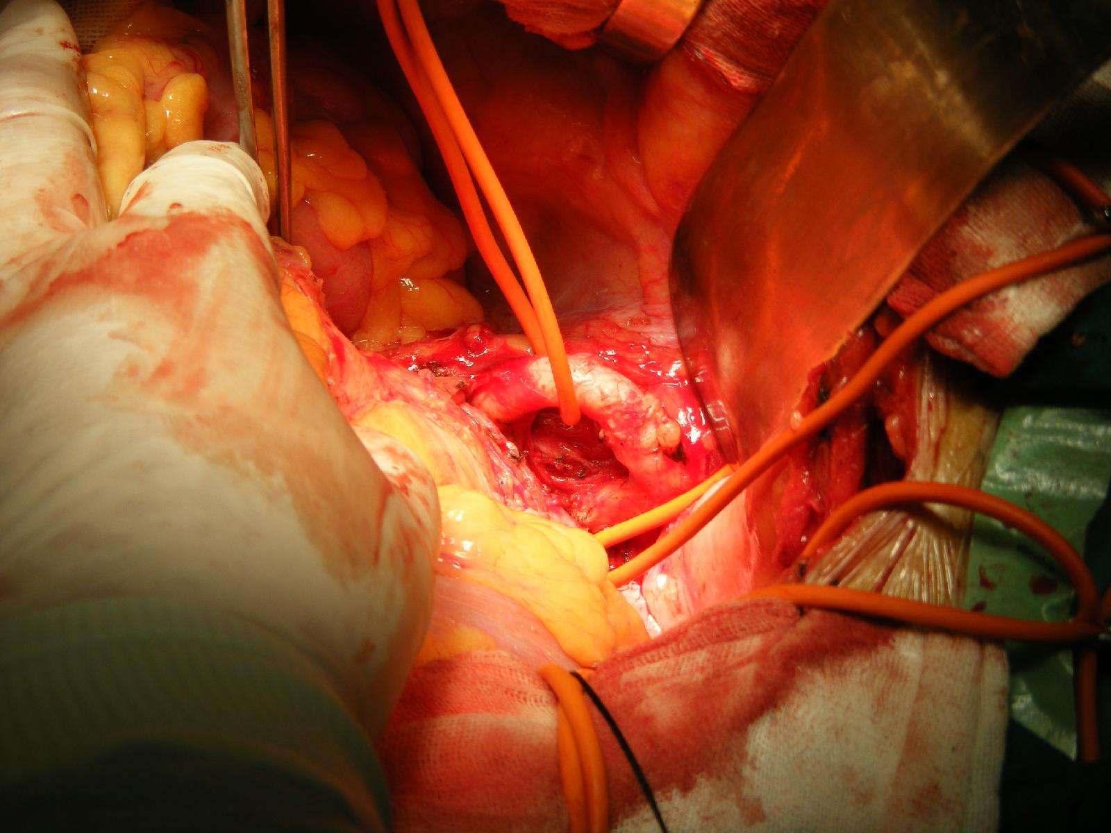 腹主动脉瘤手术中照片 - 好大夫在线