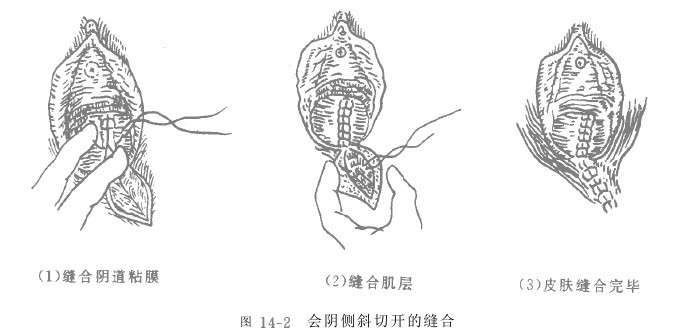 正确认识产前会阴切开