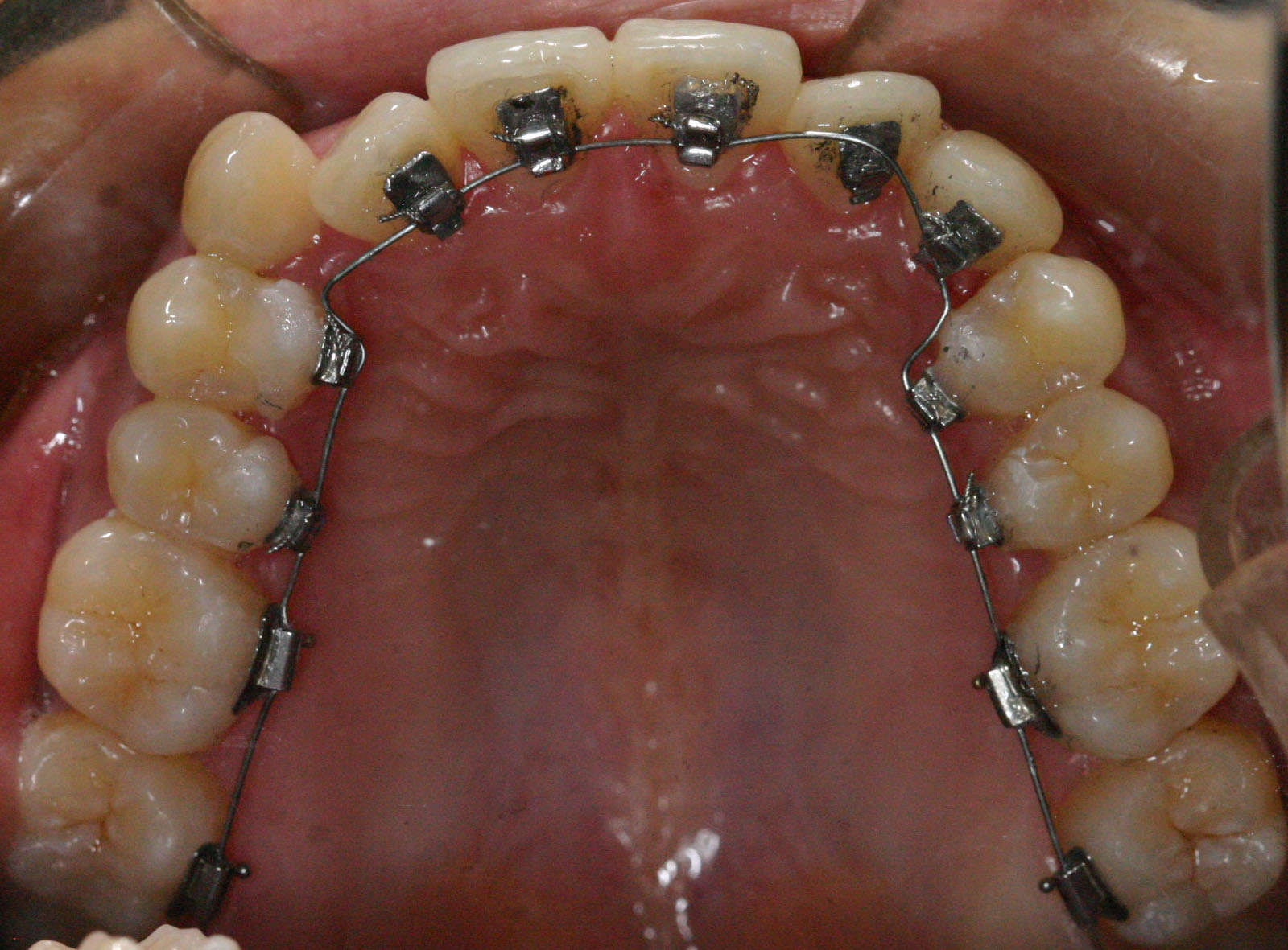 固定矫治器的选择