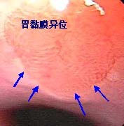 食管胃粘膜异位症图片