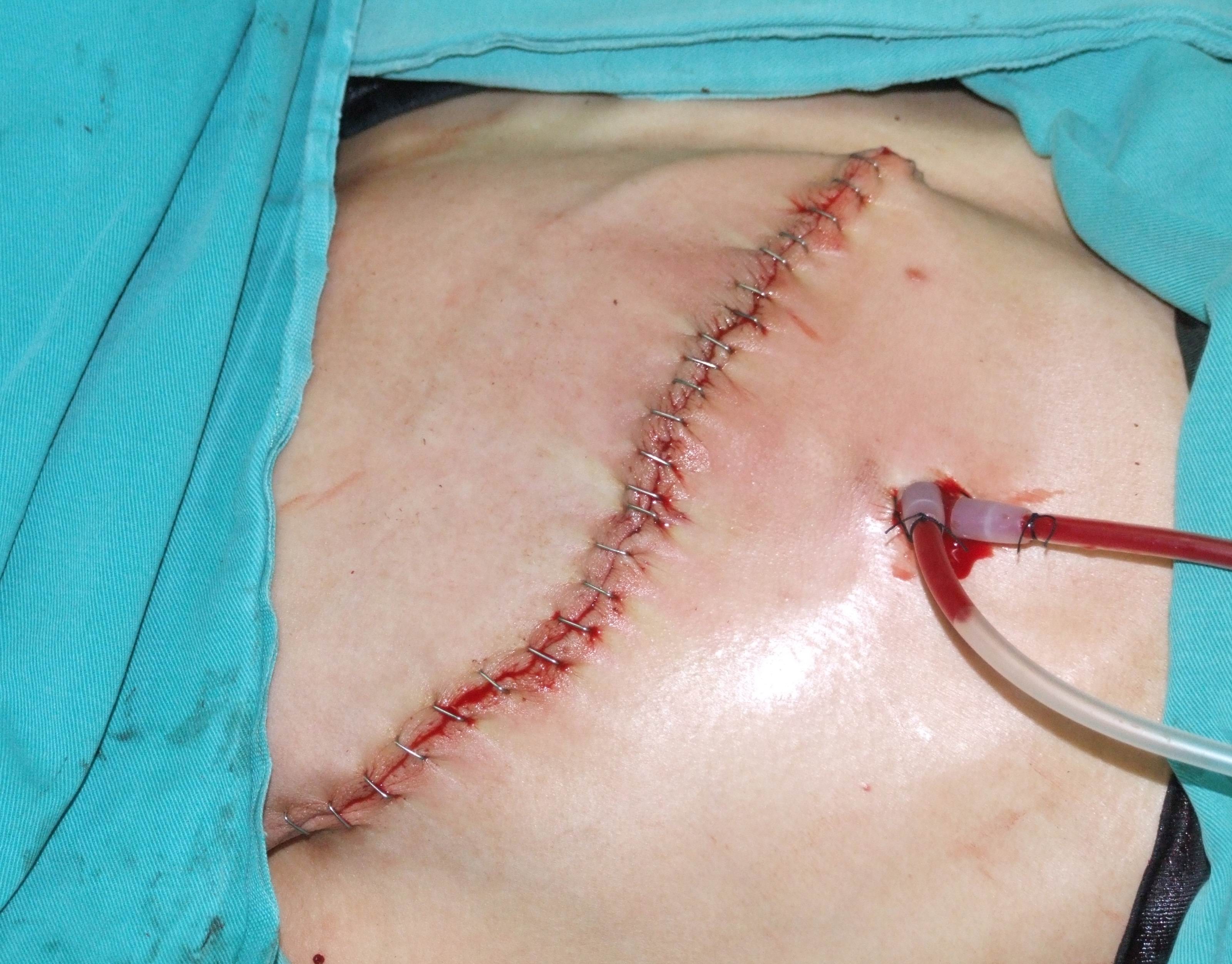 乳腺纤维瘤割下的图片图片
