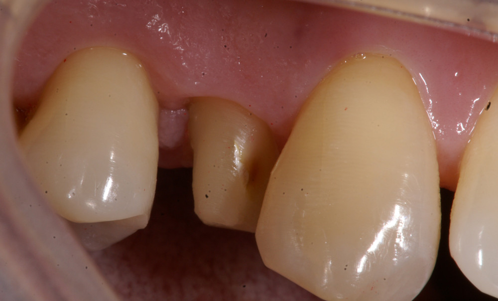 后牙全冠修复一例 - 好大夫在线