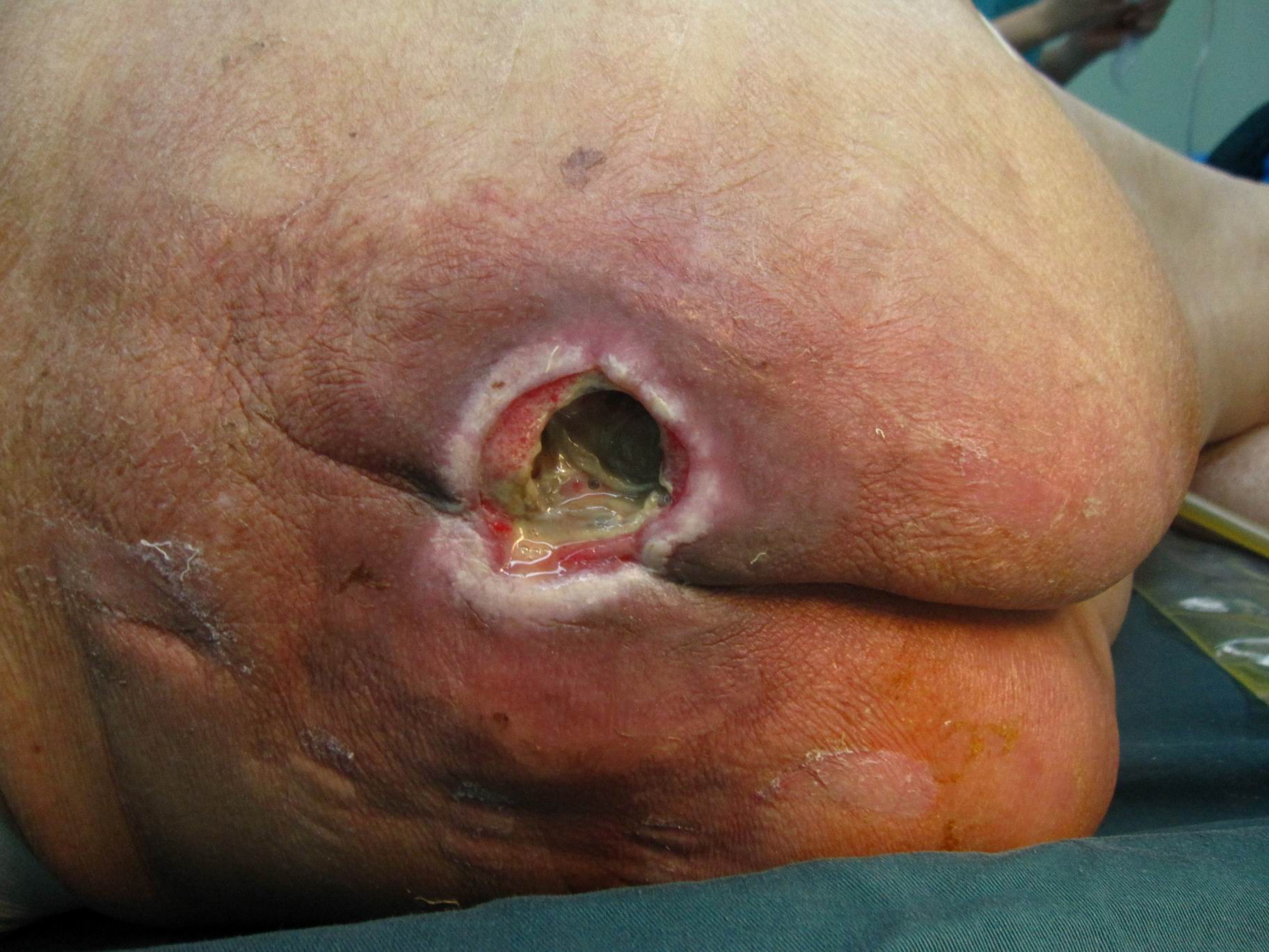 封闭式负压吸引治疗褥疮