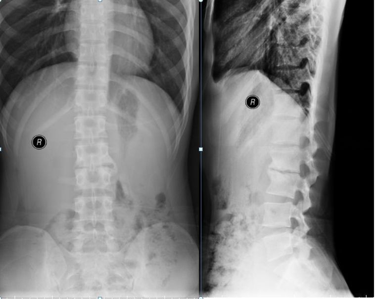 脊柱结核病例2:腰椎结核前路病灶清除植骨后路内固定术 - 好大夫在线