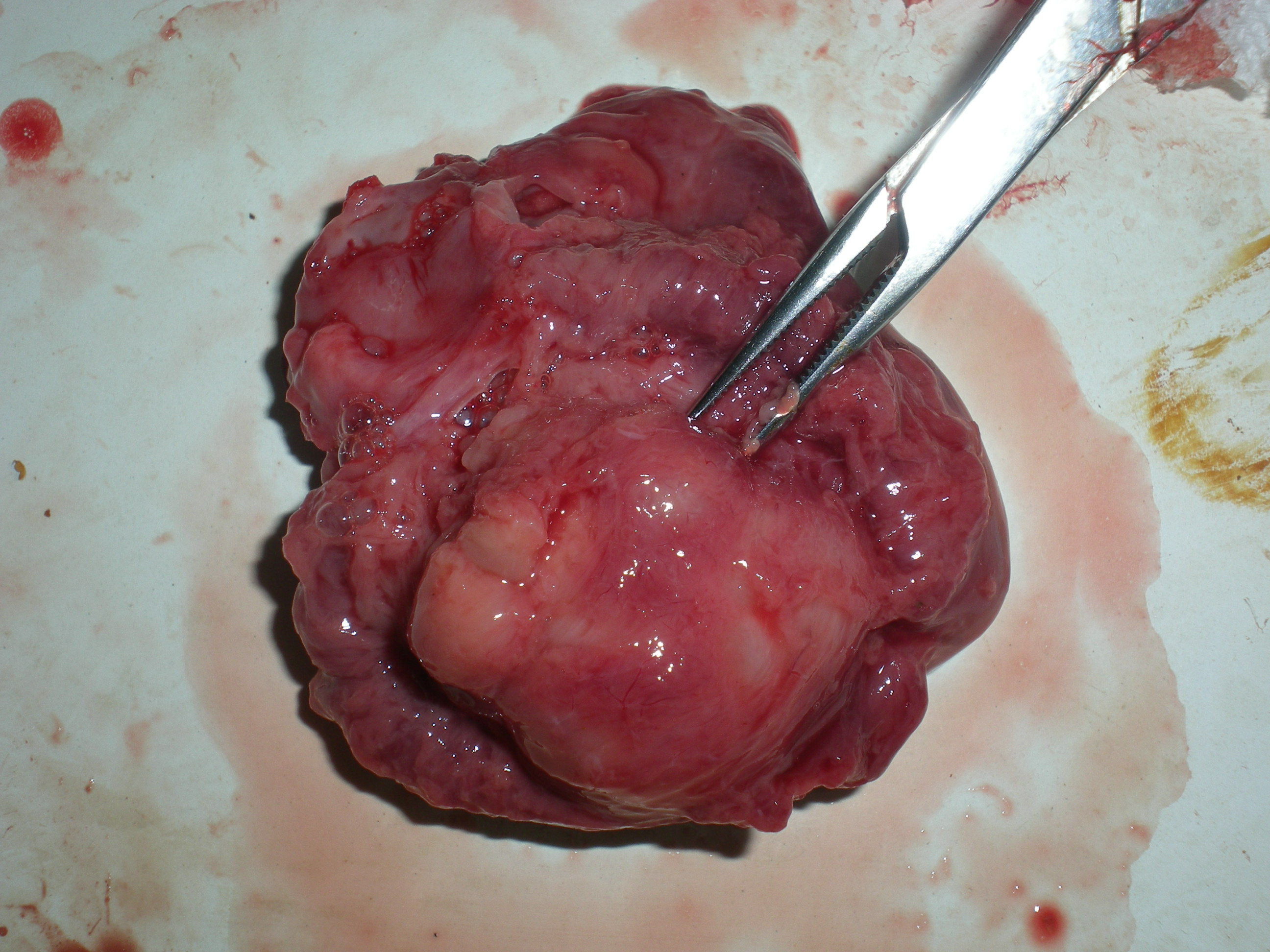 胎儿心脏多发横纹肌瘤一例 